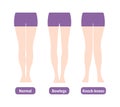 Difference types of legs angles and knees vector illustration . Normal, Bowlegs, Knock-knees.