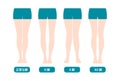 Difference types of legs angles and knees vector illustration . Normal, Bowlegs, Knock-knees.