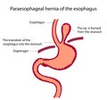 Vector illustration of stomach disease.