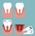 Stages of tooth decay