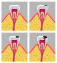 Stages of tooth decay