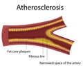 Atherosclerosis. Heart disease