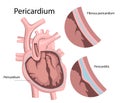 Inflammation of the pericardium. Heart disease