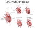 Congenital heart disease. Heart disease Royalty Free Stock Photo