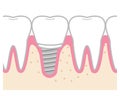 Implant treated teeth