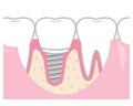 Implant treated teeth