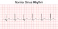 Electrocardiogram show normal heart beat line Sinus rhythm. Royalty Free Stock Photo