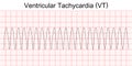 Electrocardiogram show monomorphic ventricular tachycardia VT. Royalty Free Stock Photo