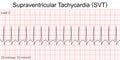 Electrocardiogram show Supraventricular tachycardia SVT pattern.