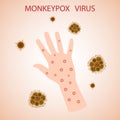Monkey pox virus on the skin. The monkey pox virus is a viral disease that can affect humans and non-human primates. Monkey pox. V