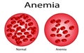 Iron deficiency anemia. Realistic vector 3d picture. Types of anemia. Vector illustration