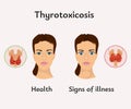 thyrotoxicosis thyroid gland medical poster Royalty Free Stock Photo