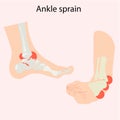 Ankle sprain vector illustration of swelling, bruising, pain, Royalty Free Stock Photo