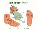 Web Diabetic Foot. Diabetes symptoms. Royalty Free Stock Photo