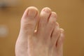 Webbed toes on the right foot.