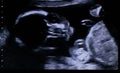 20 weeks old baby fetus face looking directly at screen during ultrasound