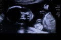 20 weeks old baby fetus face looking directly at screen during ultrasound Royalty Free Stock Photo