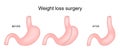 Weight loss surgery. Sleeve gastrectomy. Bariatric surgery