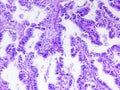 Well differentiated adenocarcinoma of a human Royalty Free Stock Photo