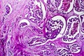 Well-differentiated intestinal adenocarcinoma, light micrograph Royalty Free Stock Photo