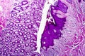 Well-differentiated intestinal adenocarcinoma, light micrograph Royalty Free Stock Photo