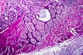 Well-differentiated intestinal adenocarcinoma, light micrograph Royalty Free Stock Photo