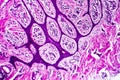 Well-differentiated intestinal adenocarcinoma, light micrograph Royalty Free Stock Photo