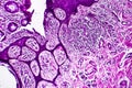 Well-differentiated intestinal adenocarcinoma, light micrograph Royalty Free Stock Photo