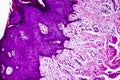 Well-differentiated intestinal adenocarcinoma, light micrograph Royalty Free Stock Photo