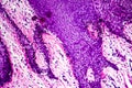 Well-differentiated intestinal adenocarcinoma, light micrograph Royalty Free Stock Photo