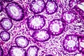 Well-differentiated intestinal adenocarcinoma, light micrograph Royalty Free Stock Photo