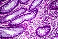 Well-differentiated intestinal adenocarcinoma, light micrograph Royalty Free Stock Photo