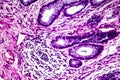 Well-differentiated intestinal adenocarcinoma, light micrograph Royalty Free Stock Photo