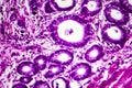 Well-differentiated intestinal adenocarcinoma, light micrograph Royalty Free Stock Photo