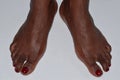 Woman& x27;s feet turned outwards