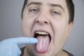 White curd on the tongue. A physician or gastroenterologist examines a manÃ¢â¬â¢s tongue. Patient has poor oral hygiene or a symptom