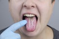 White curd on the tongue. A physician or gastroenterologist examines a manÃ¢â¬â¢s tongue. Patient has poor oral hygiene or a symptom