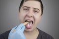 White curd on the tongue. A physician or gastroenterologist examines a manÃ¢â¬â¢s tongue. Patient has poor oral hygiene or a symptom