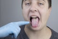 White curd on the tongue. A physician or gastroenterologist examines a manÃ¢â¬â¢s tongue. Patient has poor oral hygiene or a symptom