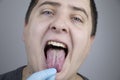 White curd on the tongue. A physician or gastroenterologist examines a manÃ¢â¬â¢s tongue. Patient has poor oral hygiene or a symptom