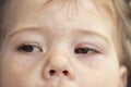 White pimple on the upper eyelid of the eye, milium. Inflammation of the eye of a small baby child, conjunctivitis. Milium is a