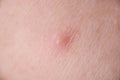 White pus pimple on skin of face closeup