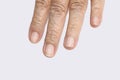 White spots on elderly fingernails Royalty Free Stock Photo