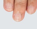 White spots on fingernails.