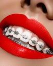 White teeth with braces. Dental care photo. Woman smile with ortodontic accessories, bright lips. Orthodontics treatment