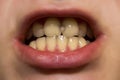 White teeth with caries