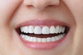 White teeth of a caucasian woman after treatment and whitening of teeth, dental crowns.