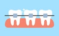 White teeth with dental braces vector flat illustration. Alignment of bite of teeth. Dental clinic service concept.