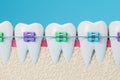 White teeth model with colorful braces