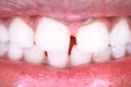 White teeth and pink gums while smiling red lips Royalty Free Stock Photo